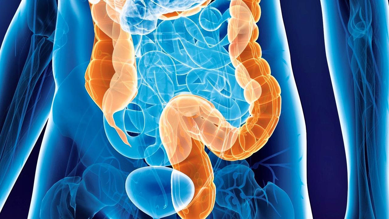 Symbolbild Darmkrebs