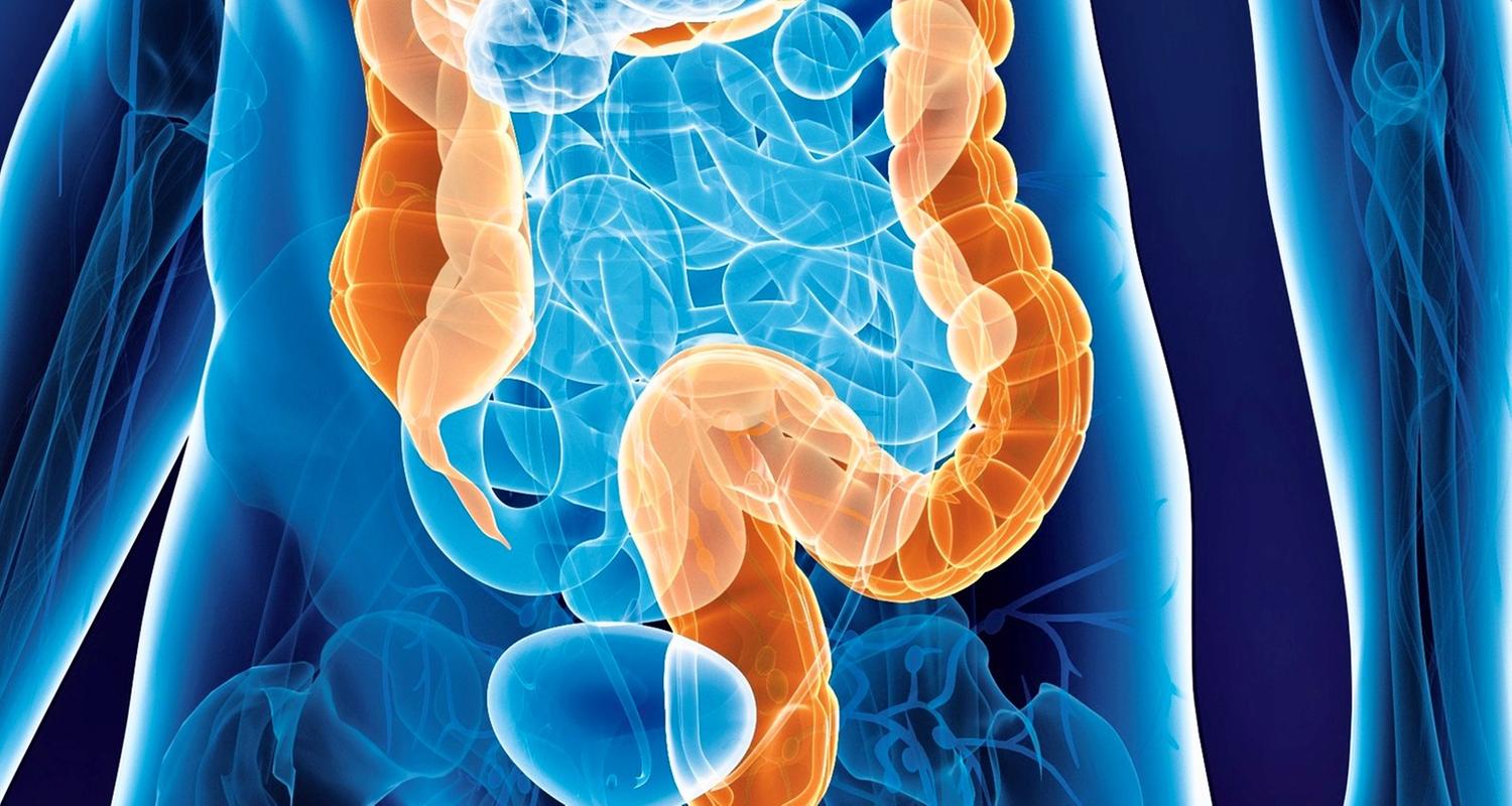 Symbolbild Darmkrebs