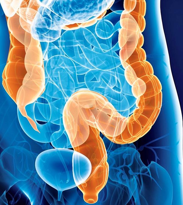 Symbolbild Darmkrebs