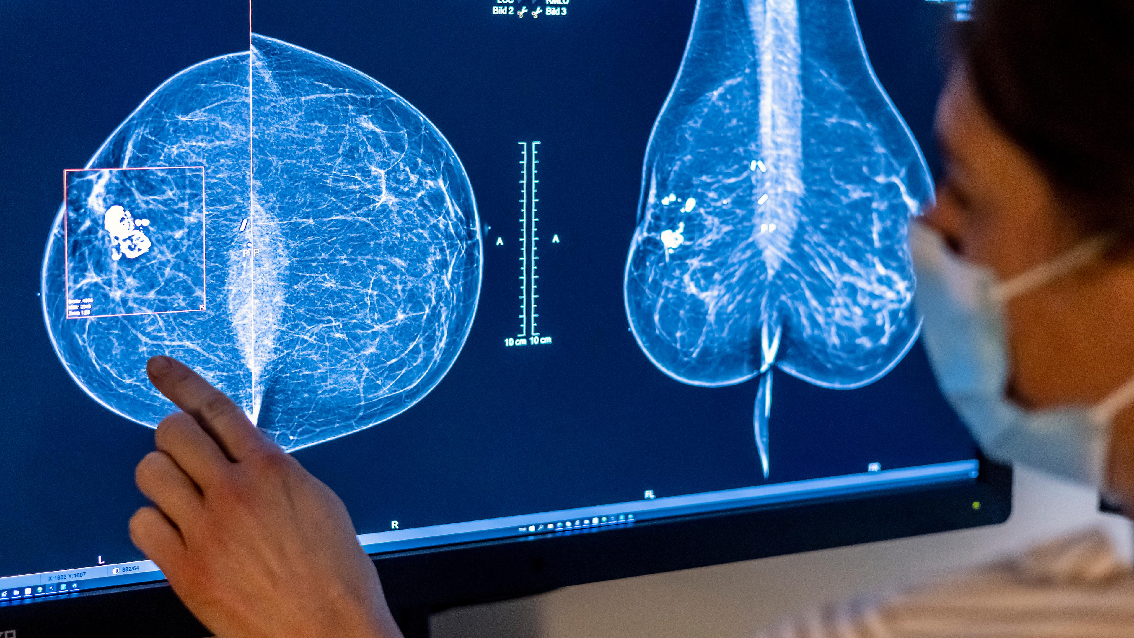 Aufnahmen einer Mammografie