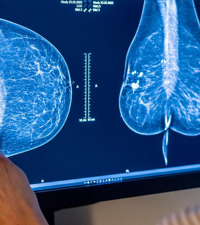 Aufnahmen einer Mammografie