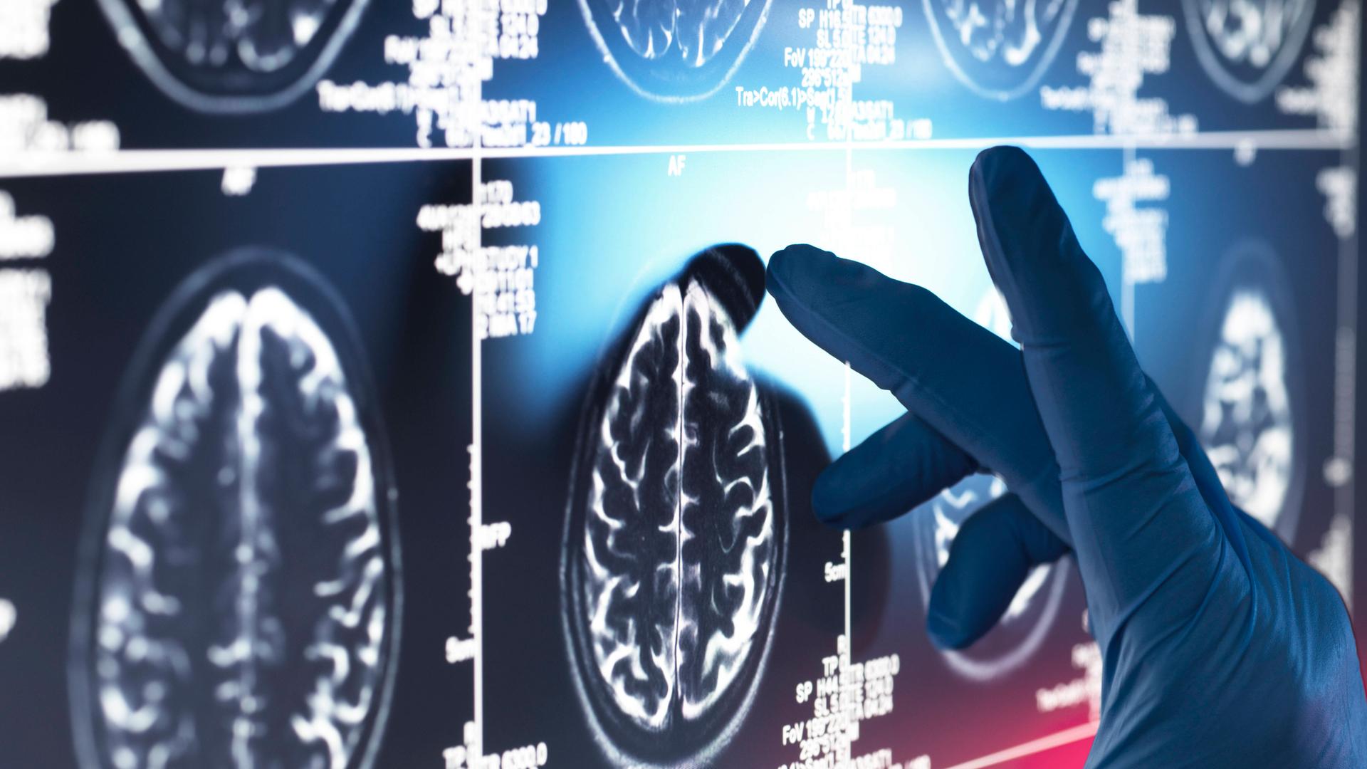Hirnscans