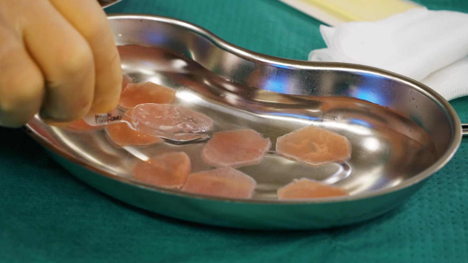 Das Herzpflaster besteht aus Millionen von Zellen und soll helfen, die Herzfunktion bei schwerer Herzinsuffizienz zu verbessern. Die Operation erfolgt minimalinvasiv,