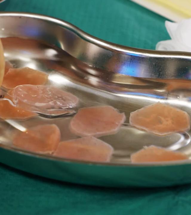 Das Herzpflaster besteht aus Millionen von Zellen und soll helfen, die Herzfunktion bei schwerer Herzinsuffizienz zu verbessern. Die Operation erfolgt minimalinvasiv,