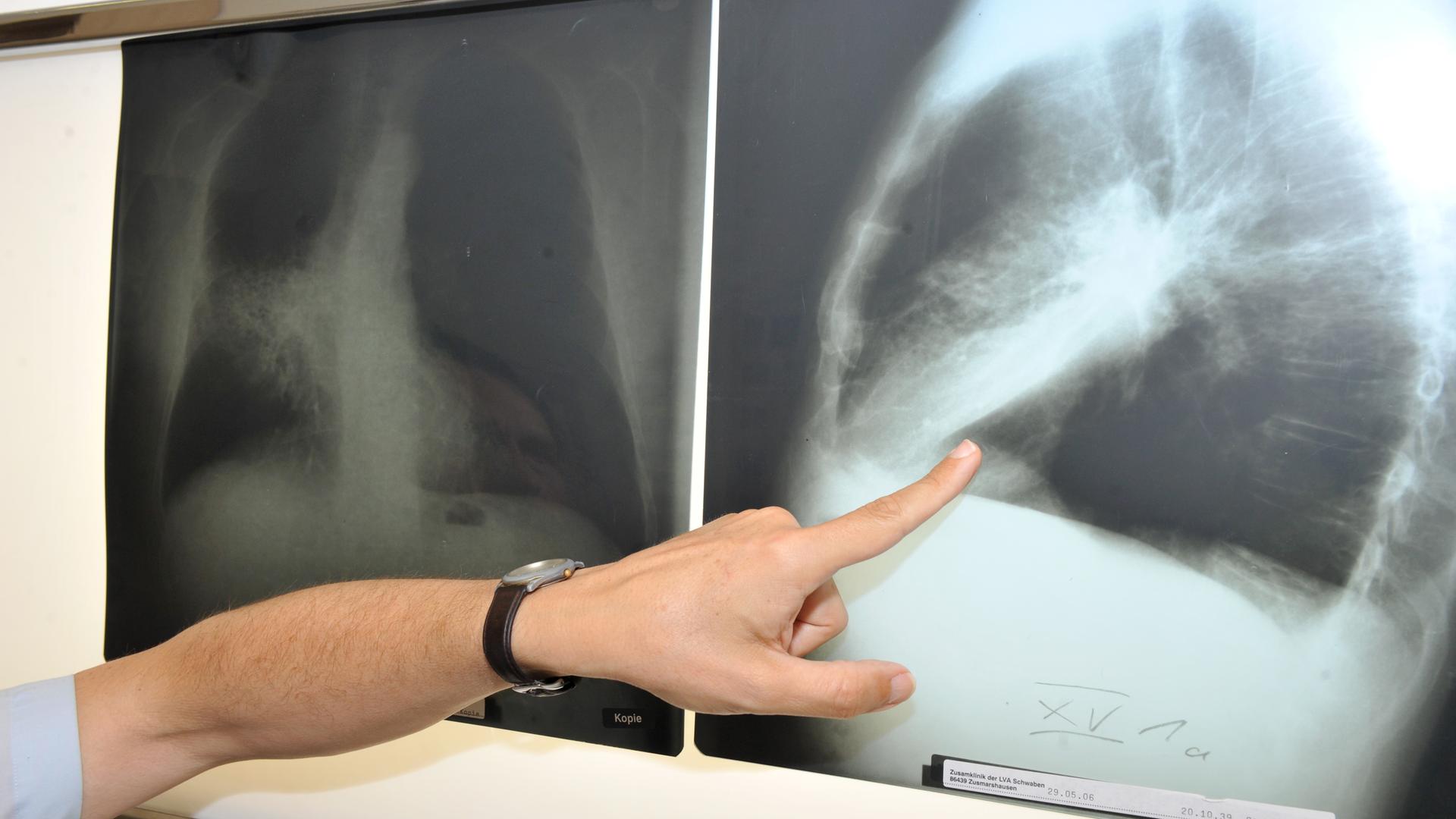 Radon verursacht tausende Lungenkrebsfälle pro Jahr. Besonders im Winter sammelt es sich in Kellern und Erdgeschossen. (Bild: Rontgenaufnahme einer Lunge)