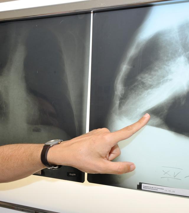 Radon verursacht tausende Lungenkrebsfälle pro Jahr. Besonders im Winter sammelt es sich in Kellern und Erdgeschossen. (Bild: Rontgenaufnahme einer Lunge)