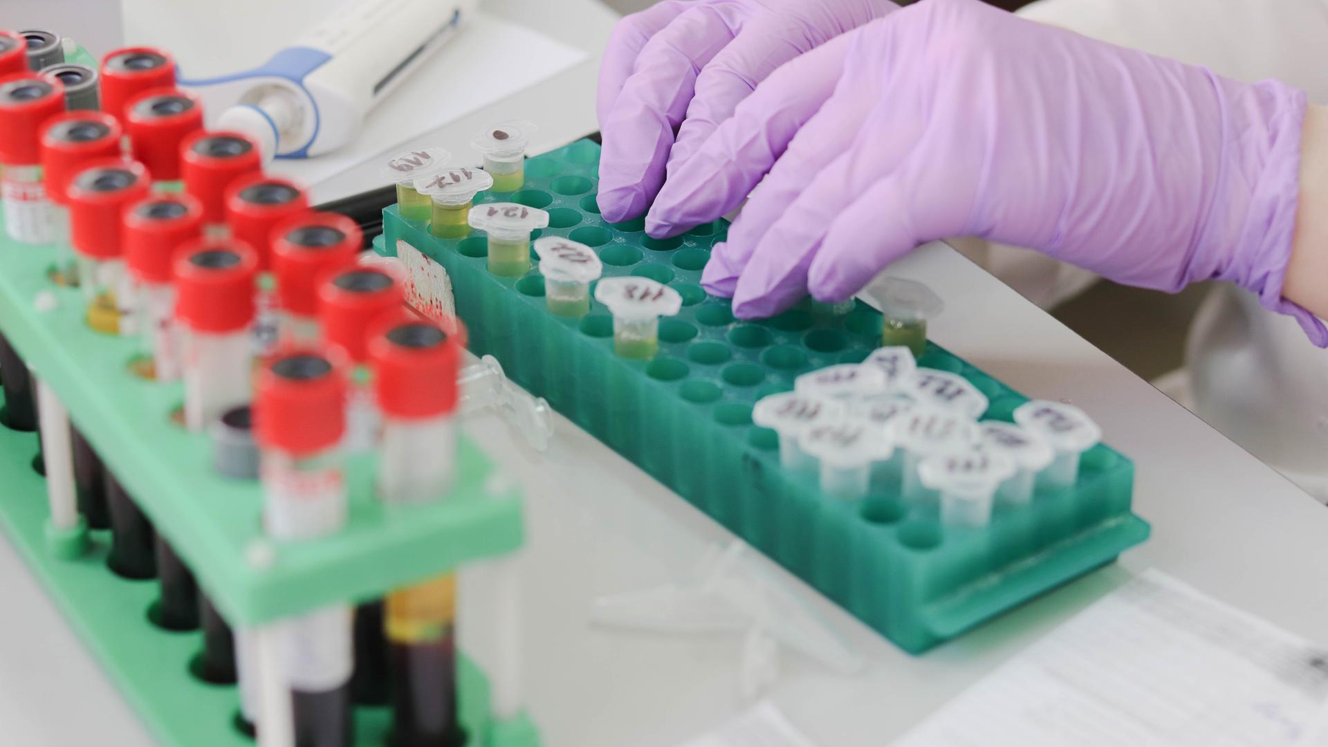 Zell-Immuntherapie - erfolge ind er Nierenkrebsforschung. (Bild zeigt eine Laborumgebung, in der Proben verarbeitet werden)