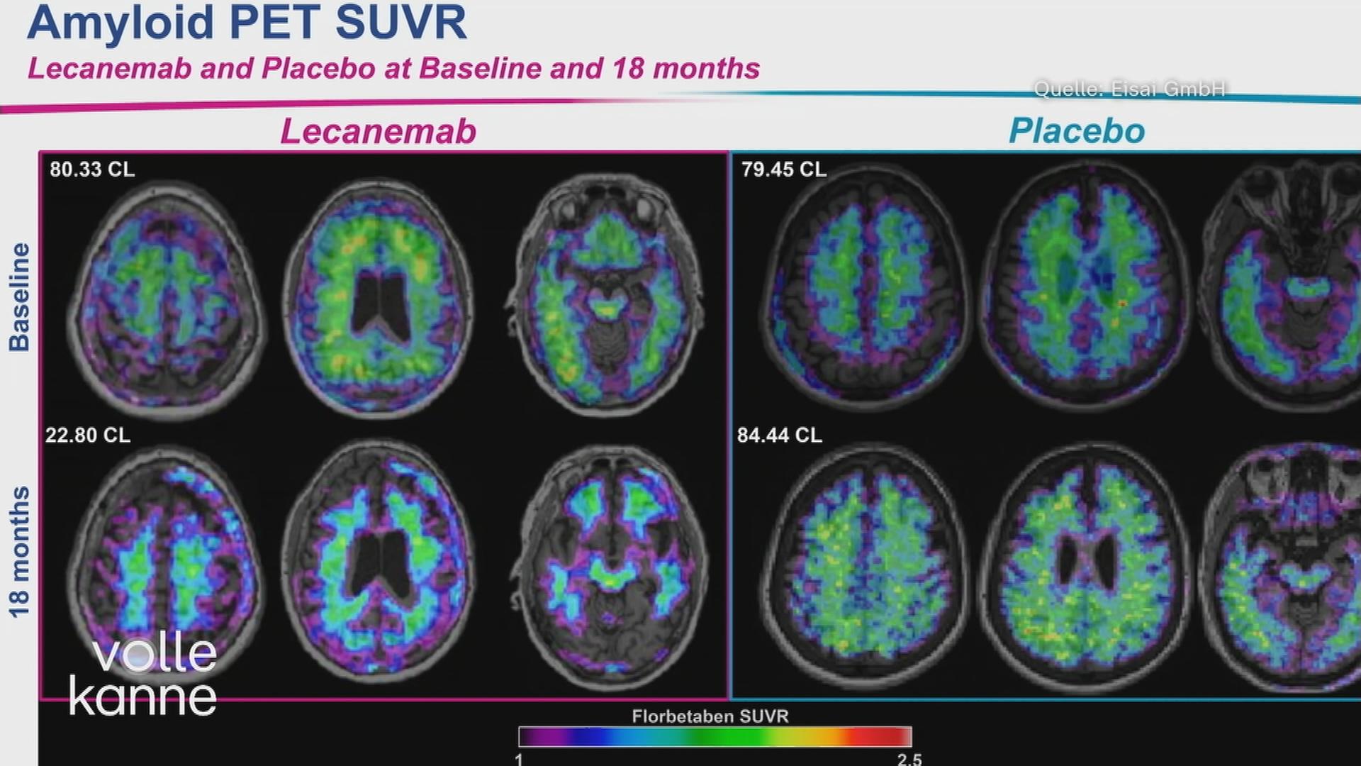 Studie zu neuen Alzheimer-Medikamenten zeigt sichtbare Wirkung im Gehirn.
