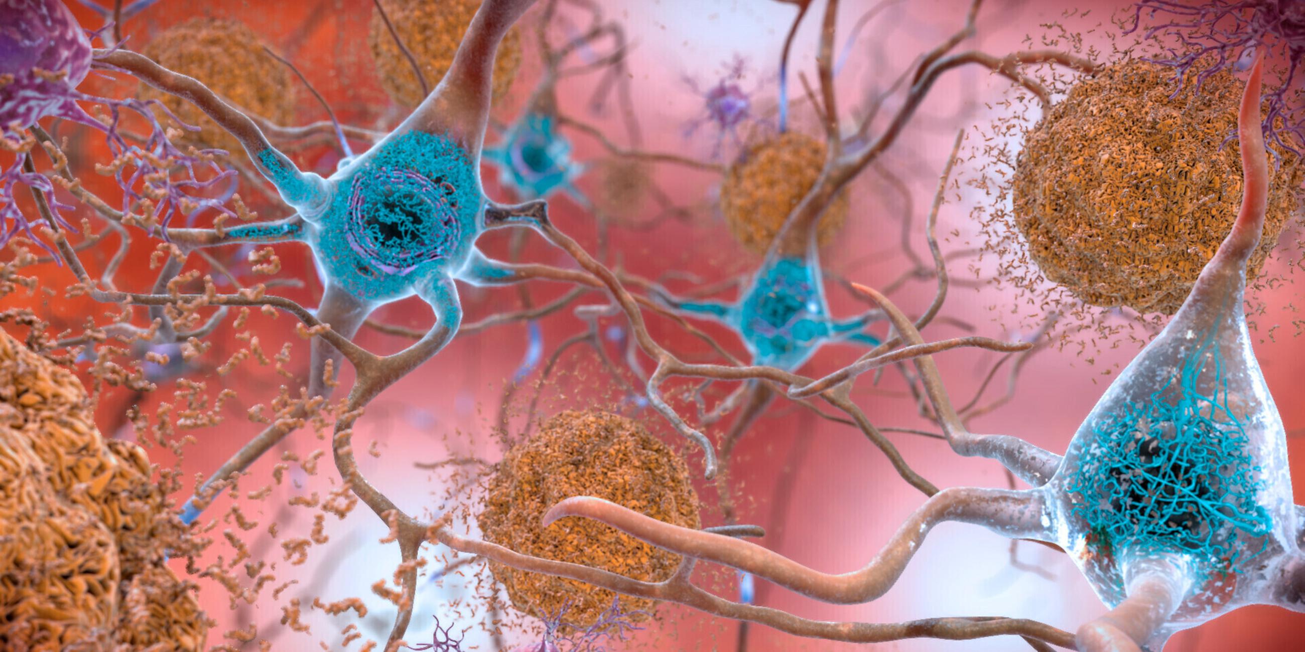 Illustration von Nervenzellen eines Gehirns mit Alzheimer