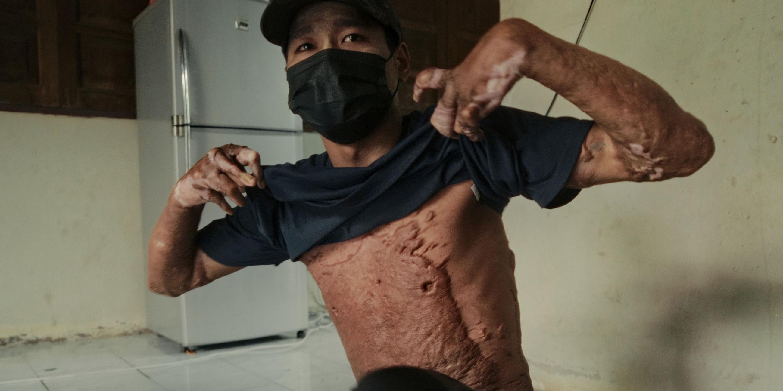 Der 19-Jährige Widerstandskämpfer Aung (Name geändert) zeigt uns die Wunden, die er bei einem Anschlagsversuch erlitten hat. Thailand, 2022.