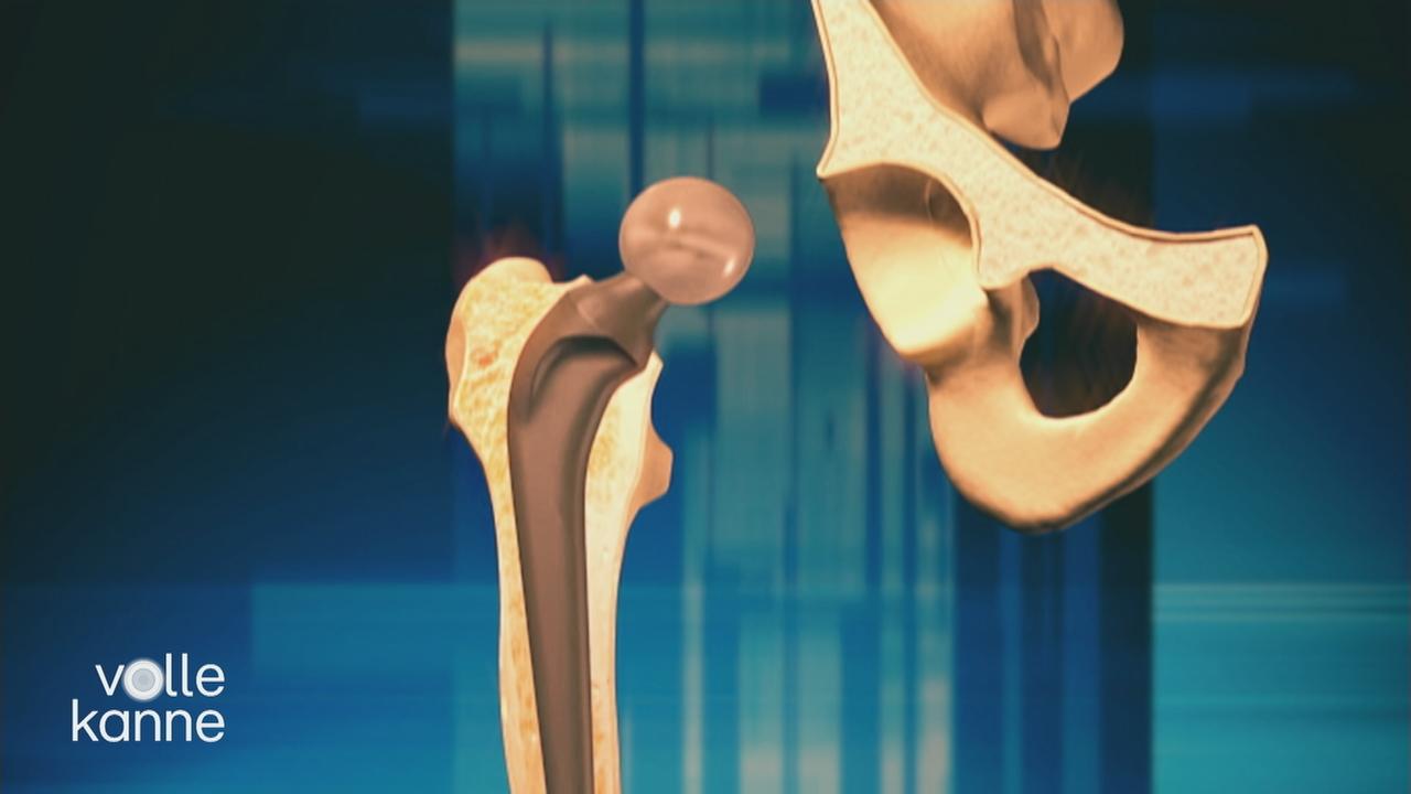 Beinlängendifferenz nach HüftOP ZDFmediathek