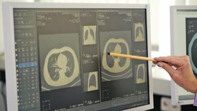 Bildschairm mit zwei CT-Scans im Vergleich