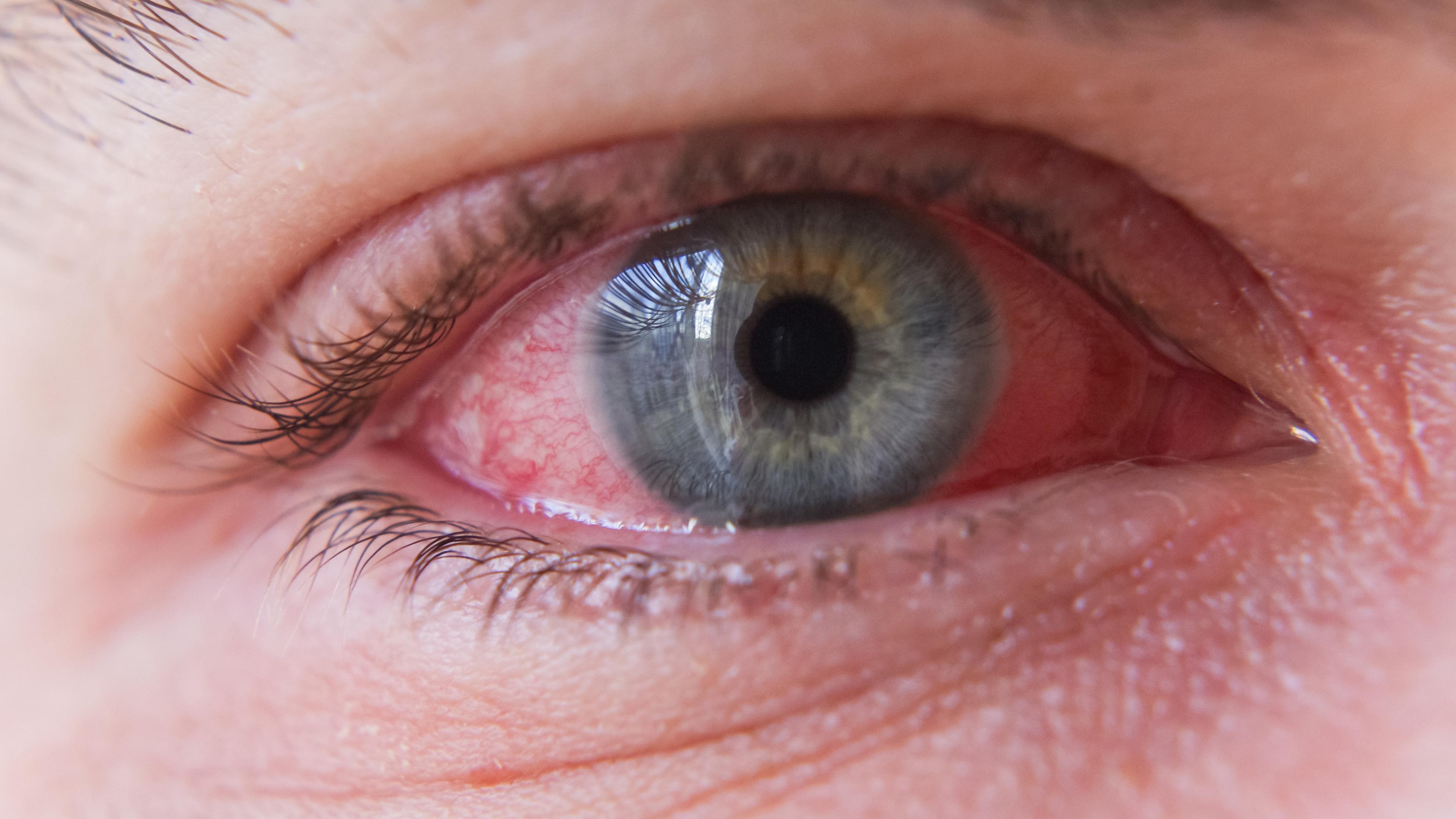 Ein Auge mit einer blauen Pupille und einer entzündeten Bindehaut