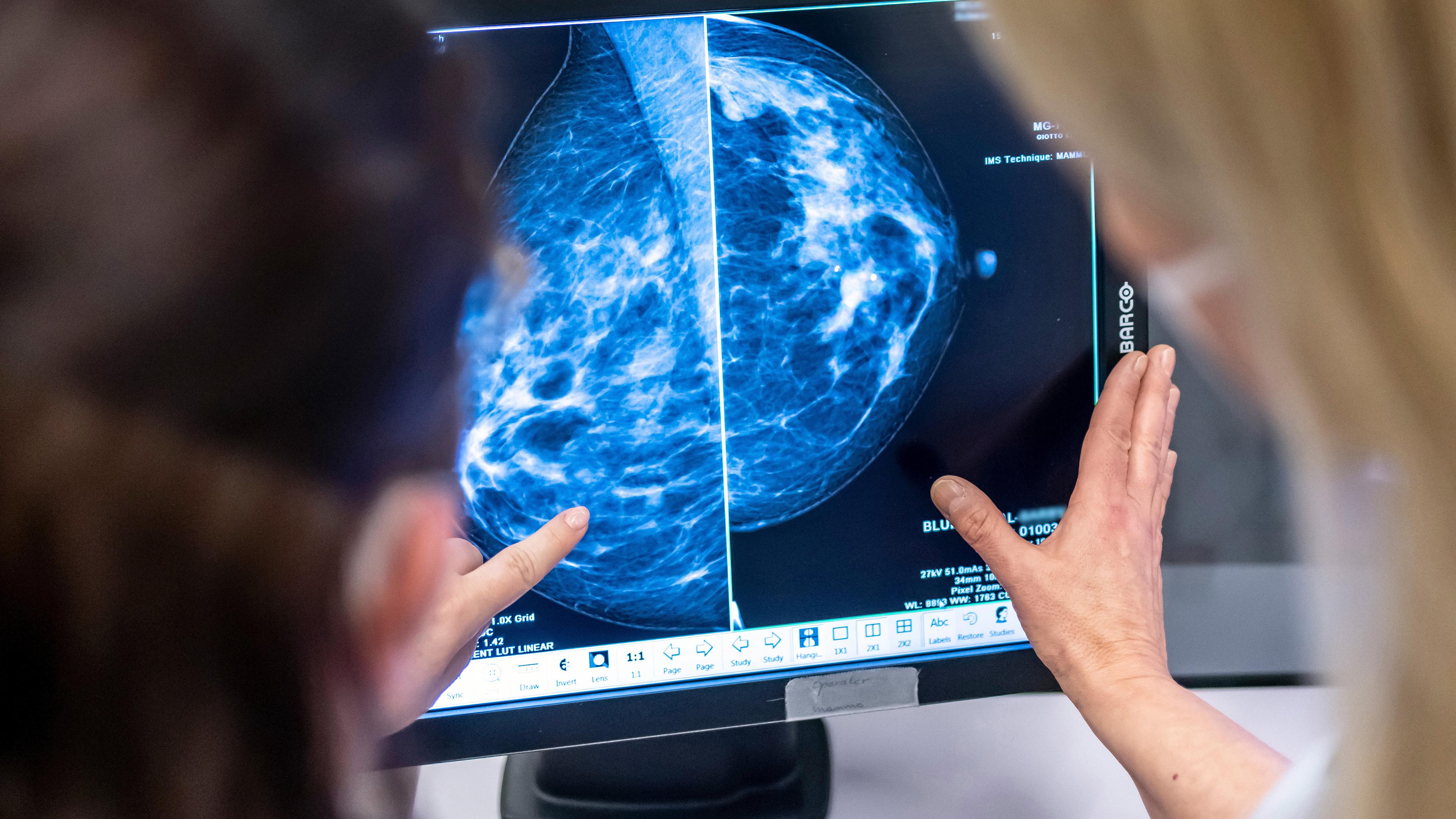 Medizinisches Personal untersucht mit einer Mammographie die Brust einer Frau auf Brustkrebs. 