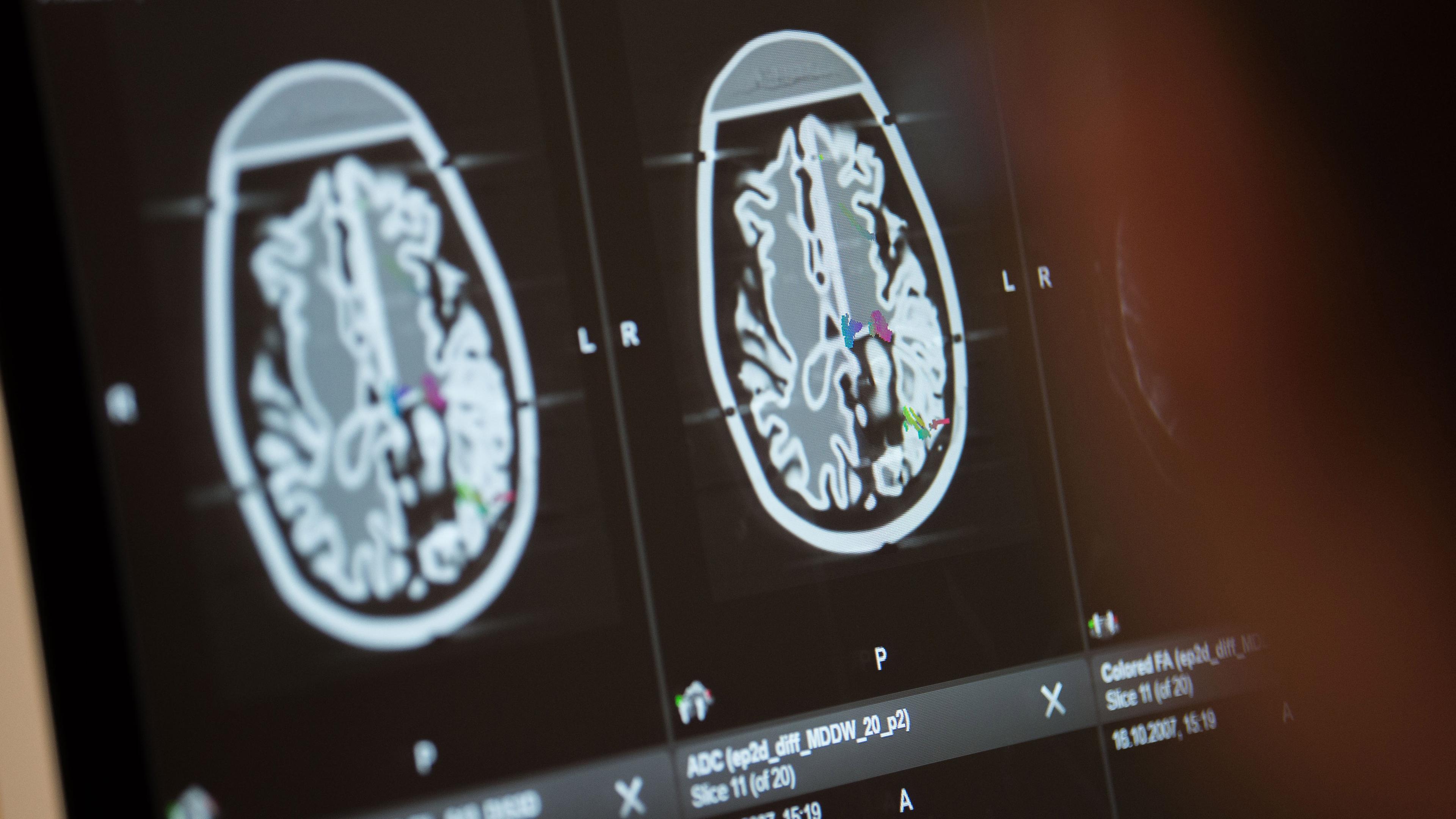 CT-Bilder eines Gehirns auf einem Bildschirm