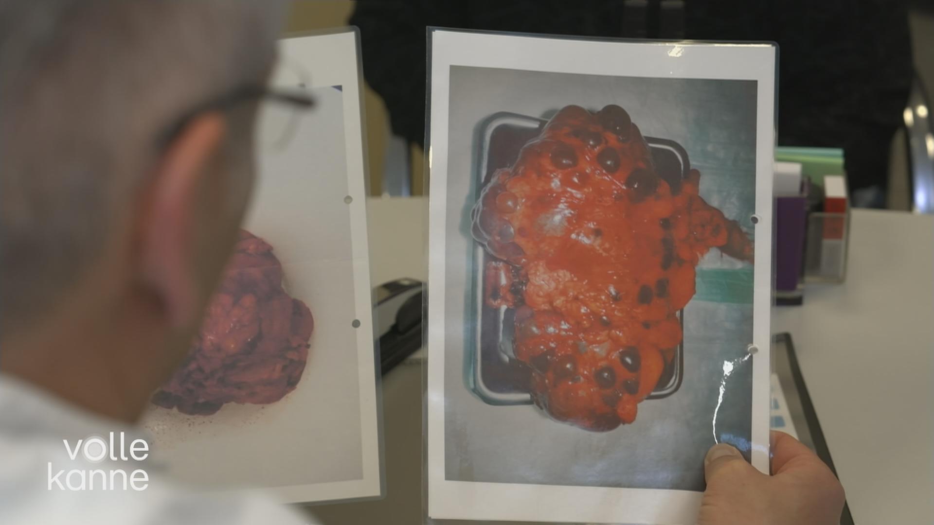 Ein Arzt schaut sich Bilder einer kranken Niere an.