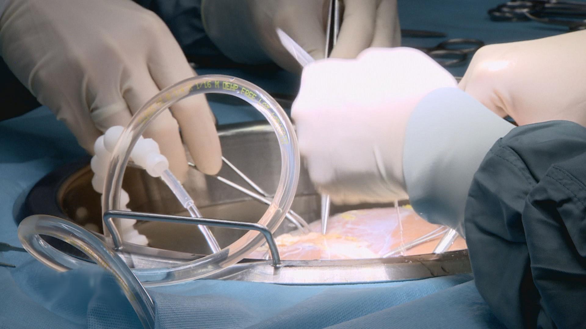 Organtransplantation.