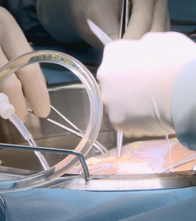 Organtransplantation.