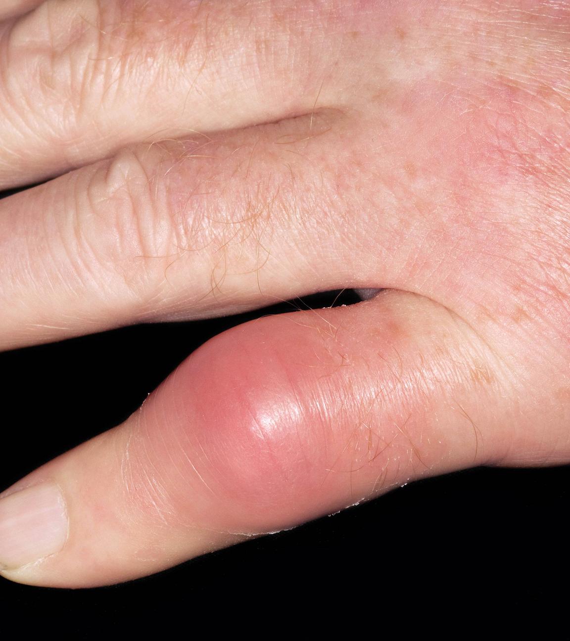 Die Hand eines Mannes mit Gicht, aufgenommen am 27.08.2014
