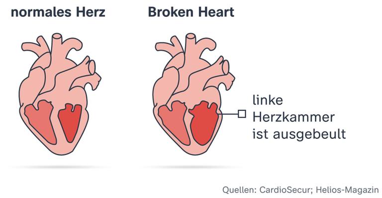 Grafik: Normales Herz und Broken-Heart-Syndom
