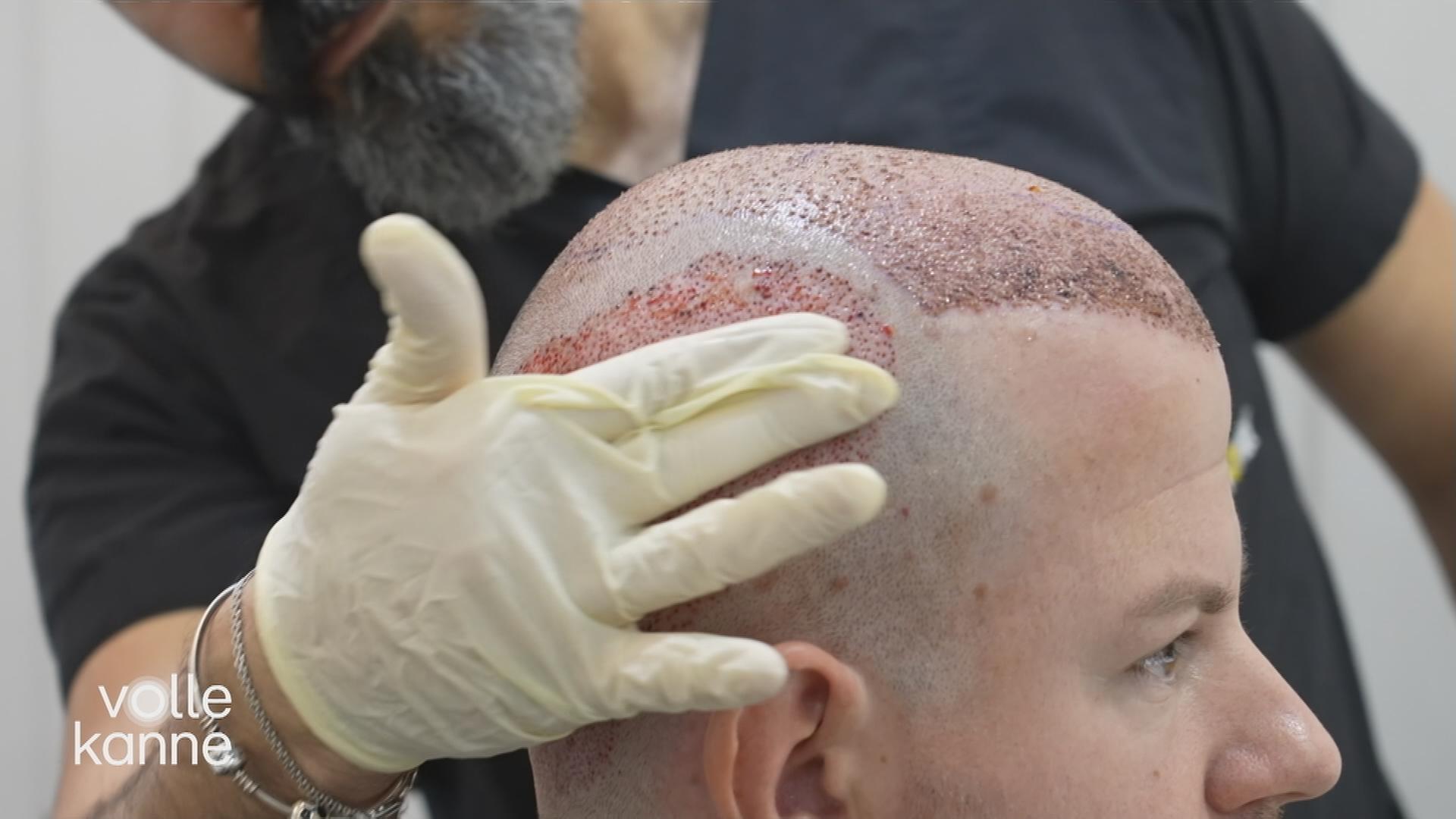 Ein Mann mit transplantierten Haarzellen.