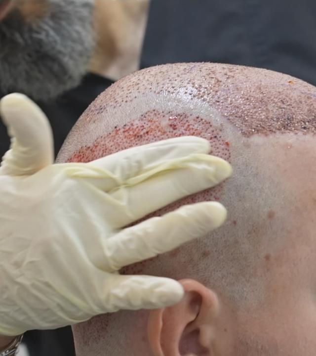 Ein Mann mit transplantierten Haarzellen.