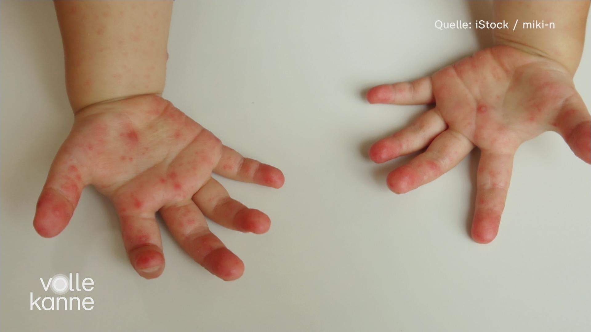 Hand-Mund-Fuß-Krankheit