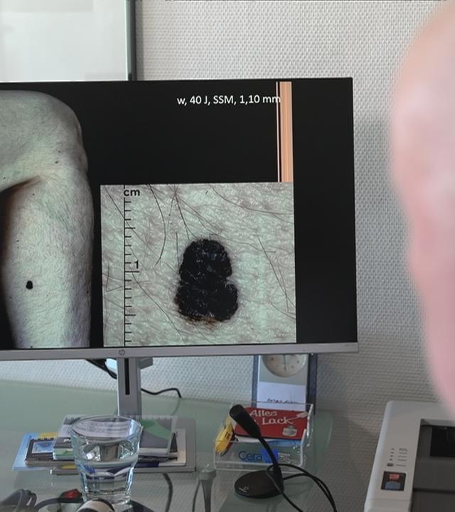 Diagnose Hautkrebs immer häufiger