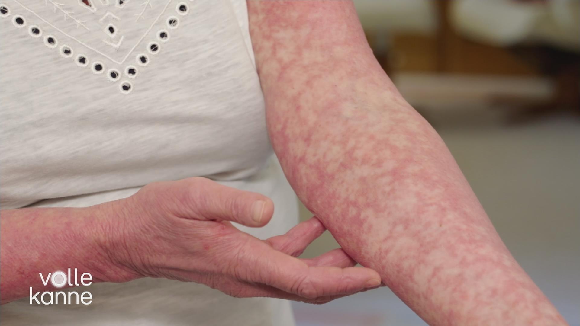 Ein Arm mit Flecken, der von der Krankheit Hautlymphome betroffen ist.