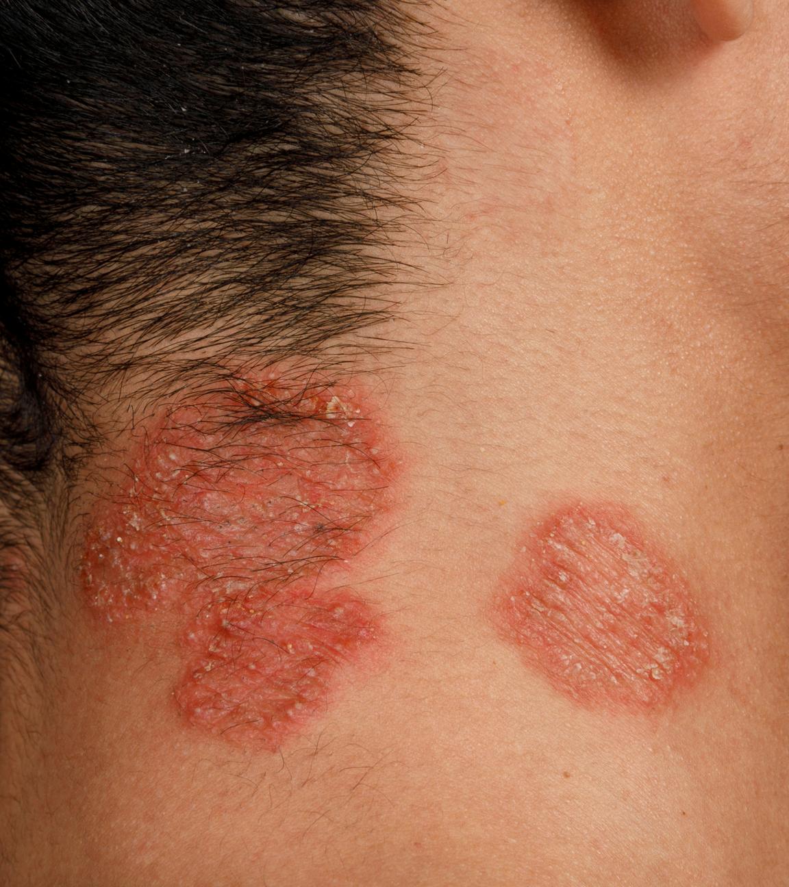Am seitlichen Kopf und Hals von einem Mann sind runde, schuppige Stellen zu sehen, die durch eine Pilzinfektion hervorgerufen wurden.
