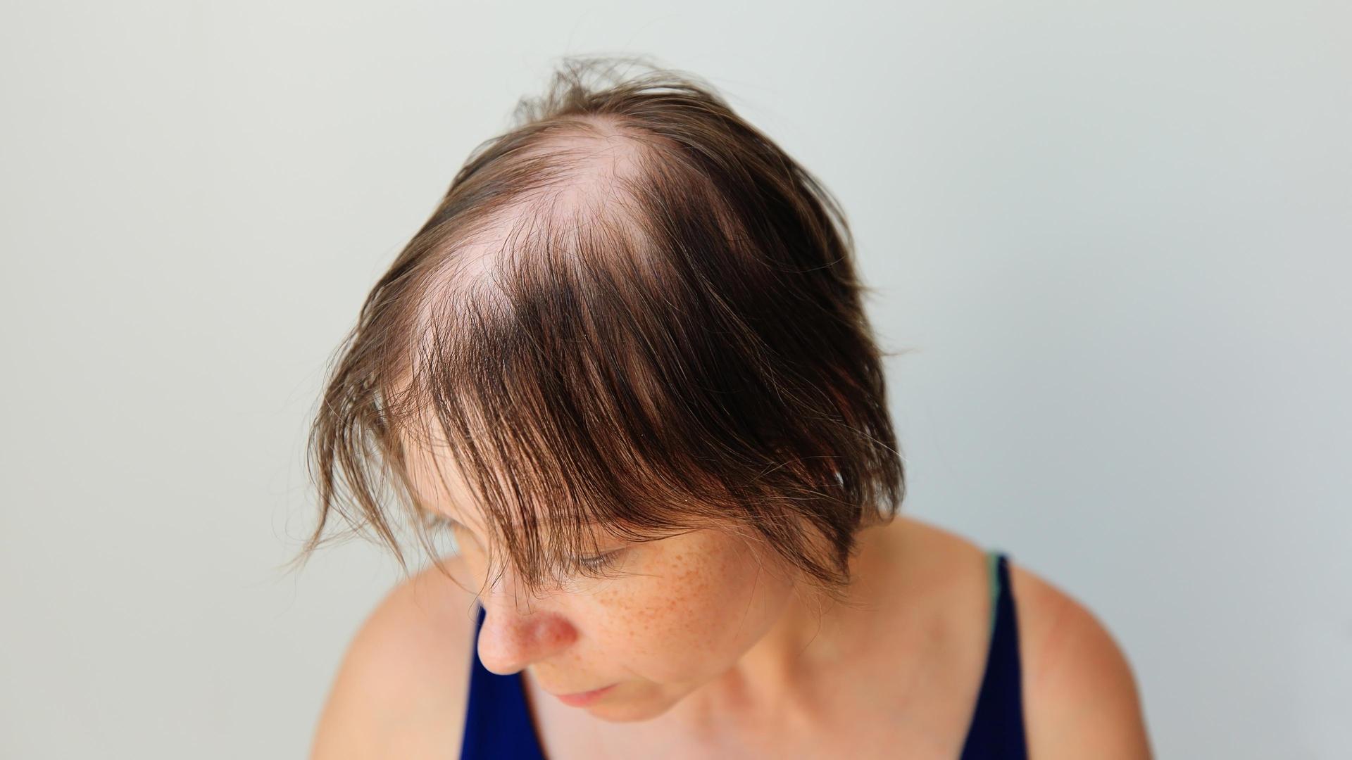 Haarausfall, Achtsam essen, gute Therapeuten