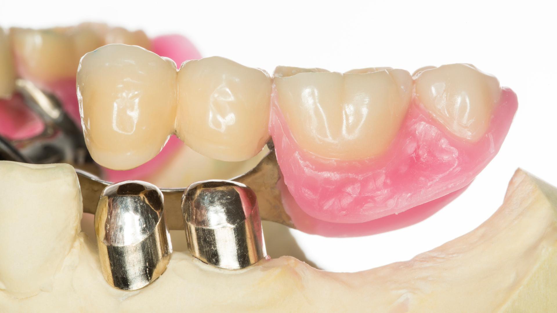 Welcher Zahnersatz?, Medikamente und Hitze, Löwenzahn