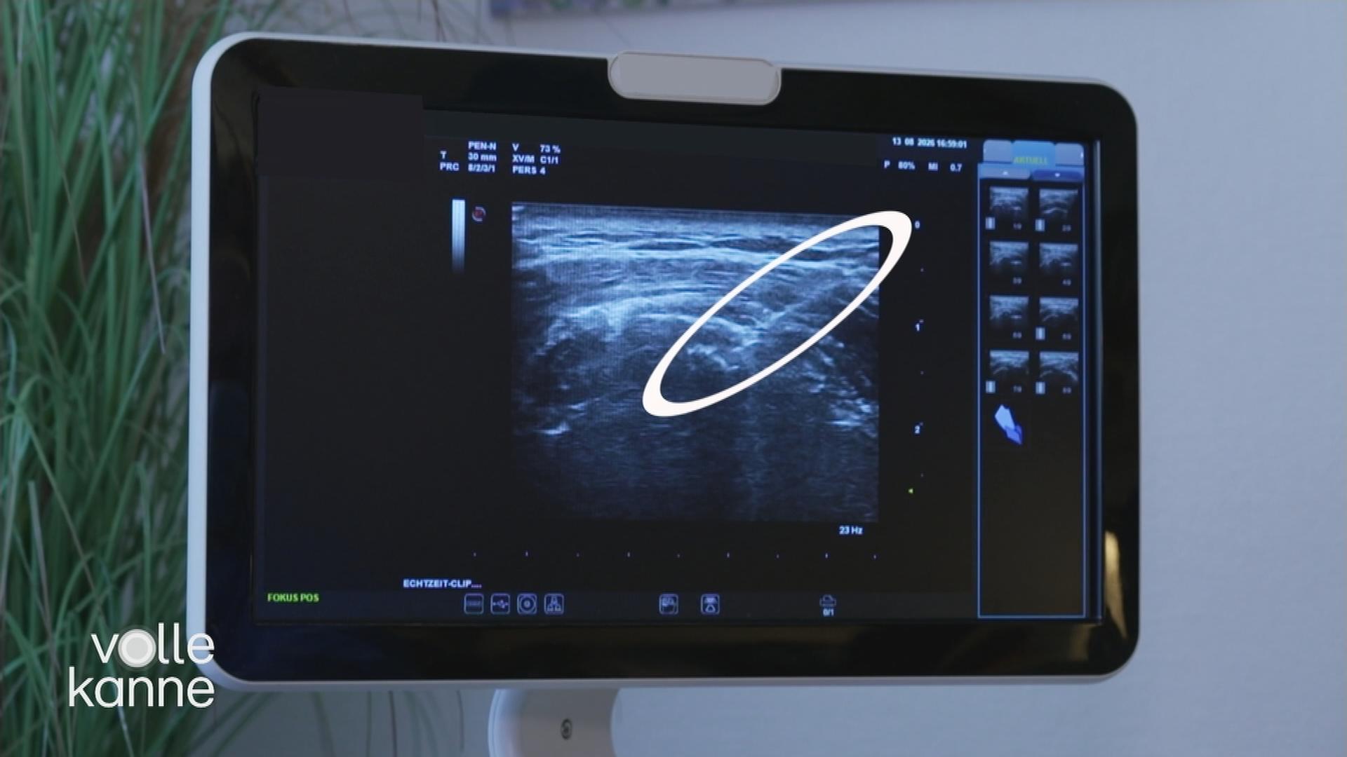 Needling bei Schulterschmerzen: Was es bringt