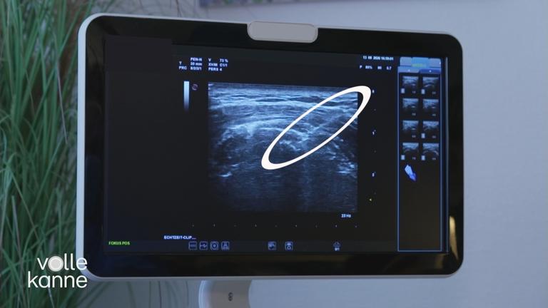 Needling bei Schulterschmerzen: Was es bringt