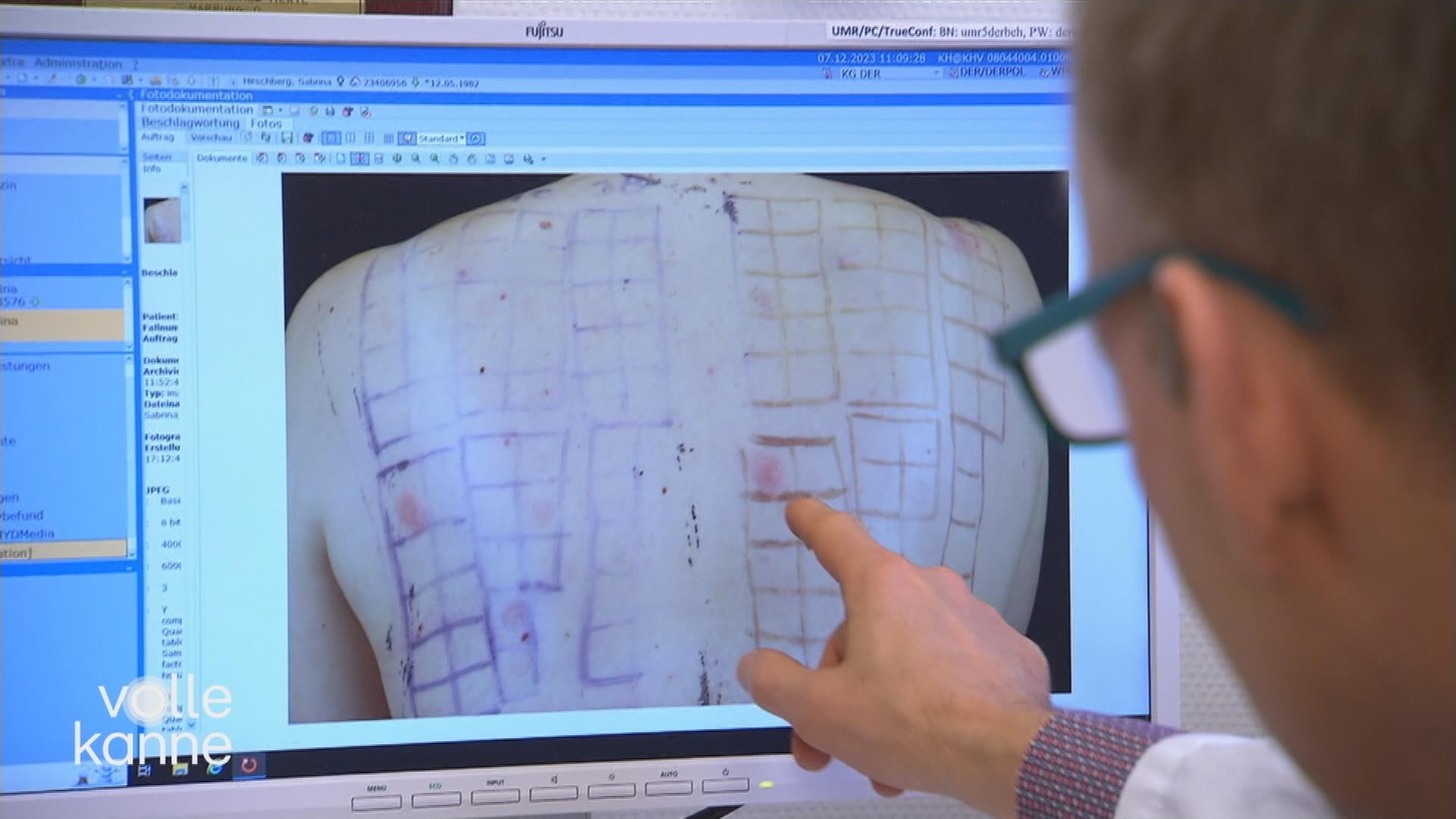 Ein Arzt zeigt auf einen Bildschirm. Dort ist ein Rücken zu sehen, auf dem Allergieproben durchgeführt wurden. 