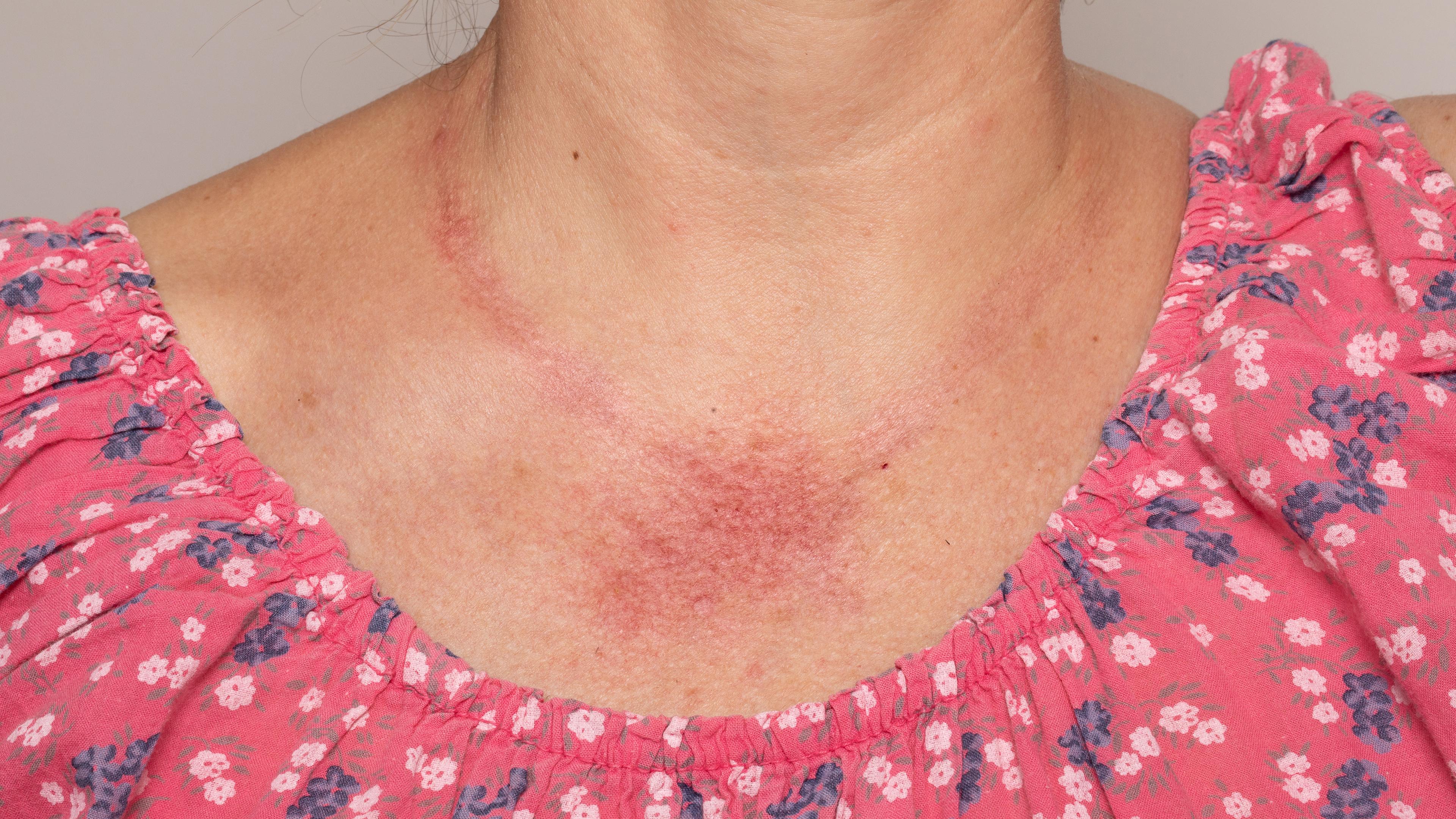 Eine allergische Reaktion am Hals einer Frau, verursacht durch eine Kette mit Anhänger.