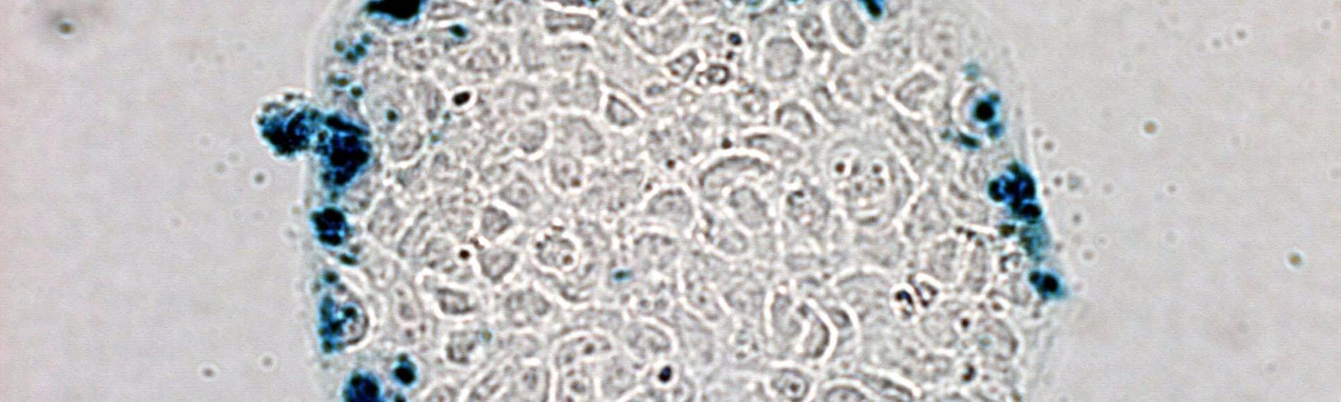 Mikroskopische Ansicht von Darmkrebszellen, denen von Wissenschaftlern genetisch veränderte E. coli Bakterien injiziert wurden.
