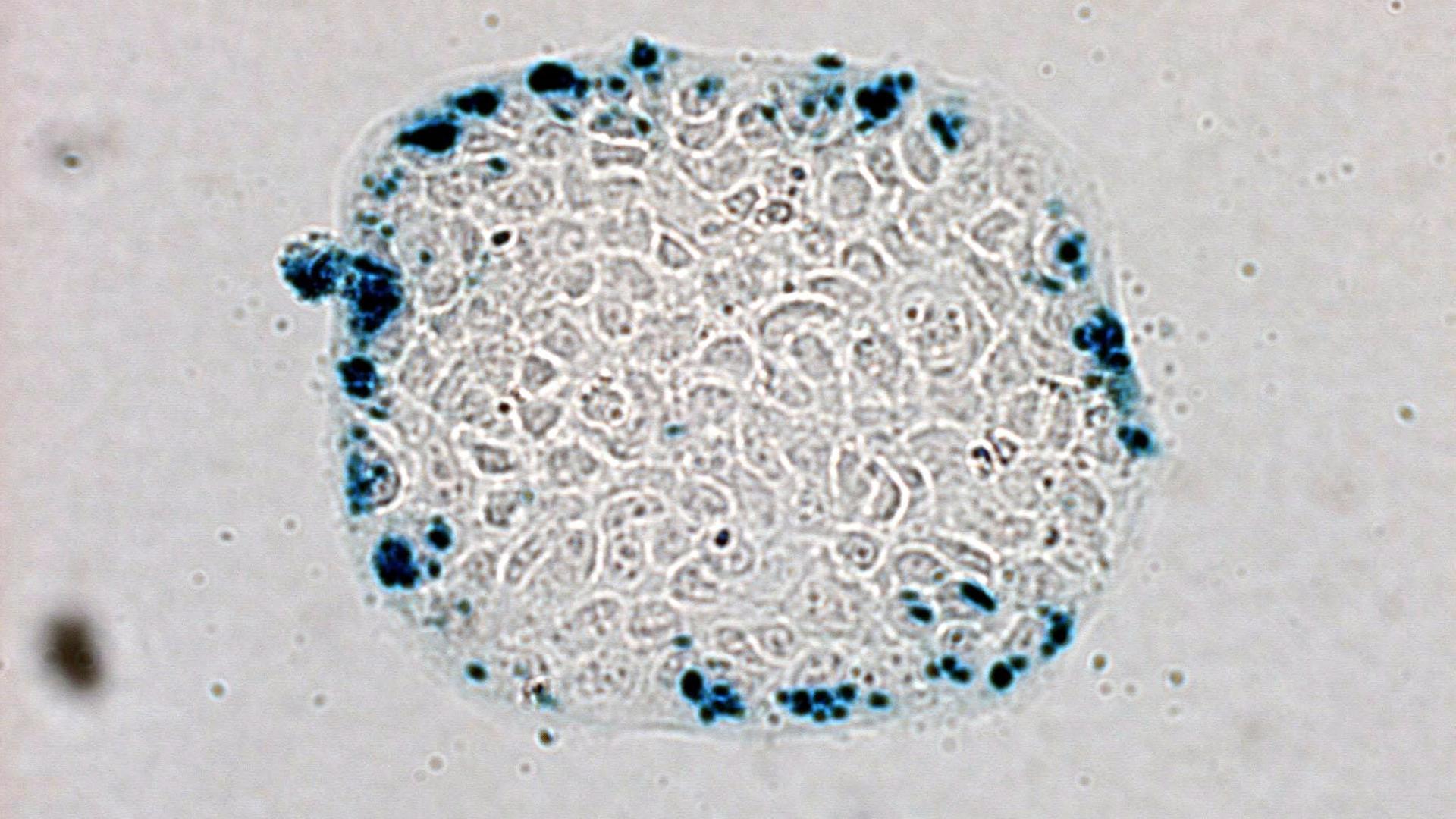 Mikroskopische Ansicht von Darmkrebszellen, denen von Wissenschaftlern genetisch veränderte E. coli Bakterien injiziert wurden.