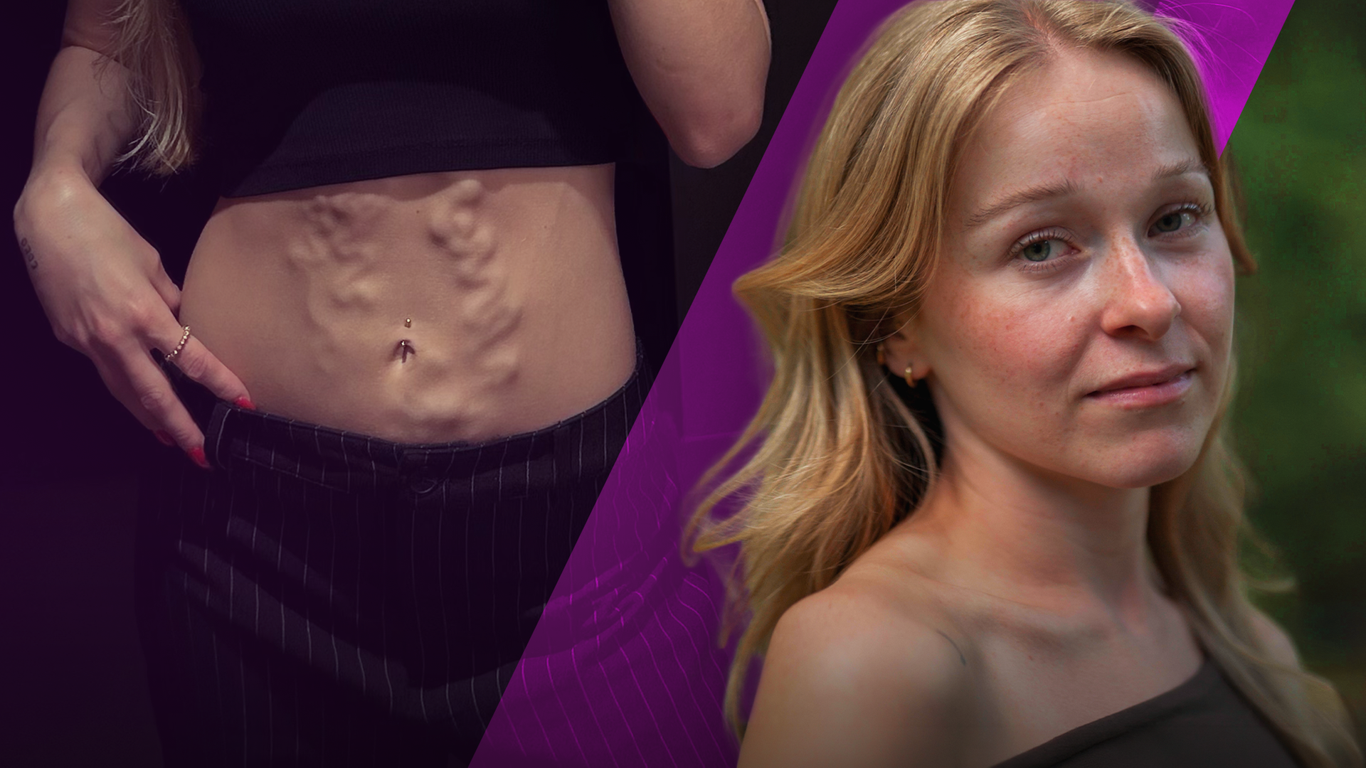 Links zeigt Lea ihren Bauch, auf dem durch die Throbose von außen die Venen sichtbar sind. Rechts daneben ist ein Bild von Lea, die in die Kamera blickt.
