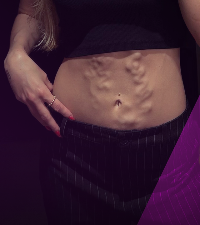Links zeigt Lea ihren Bauch, auf dem durch die Throbose von außen die Venen sichtbar sind. Rechts daneben ist ein Bild von Lea, die in die Kamera blickt.