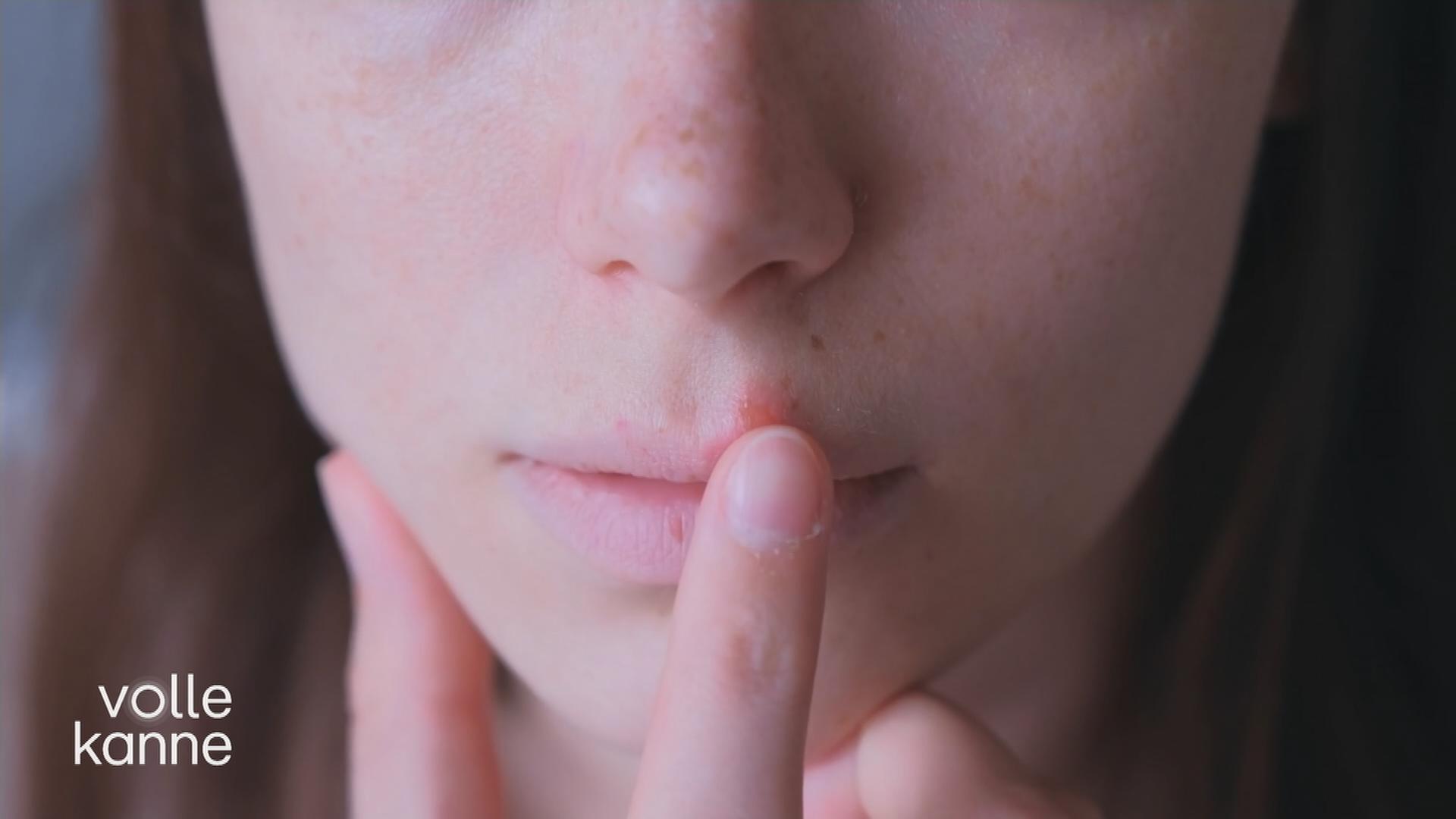 Lippenherpes