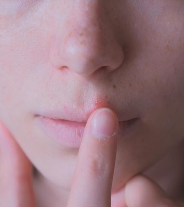 Lippenherpes