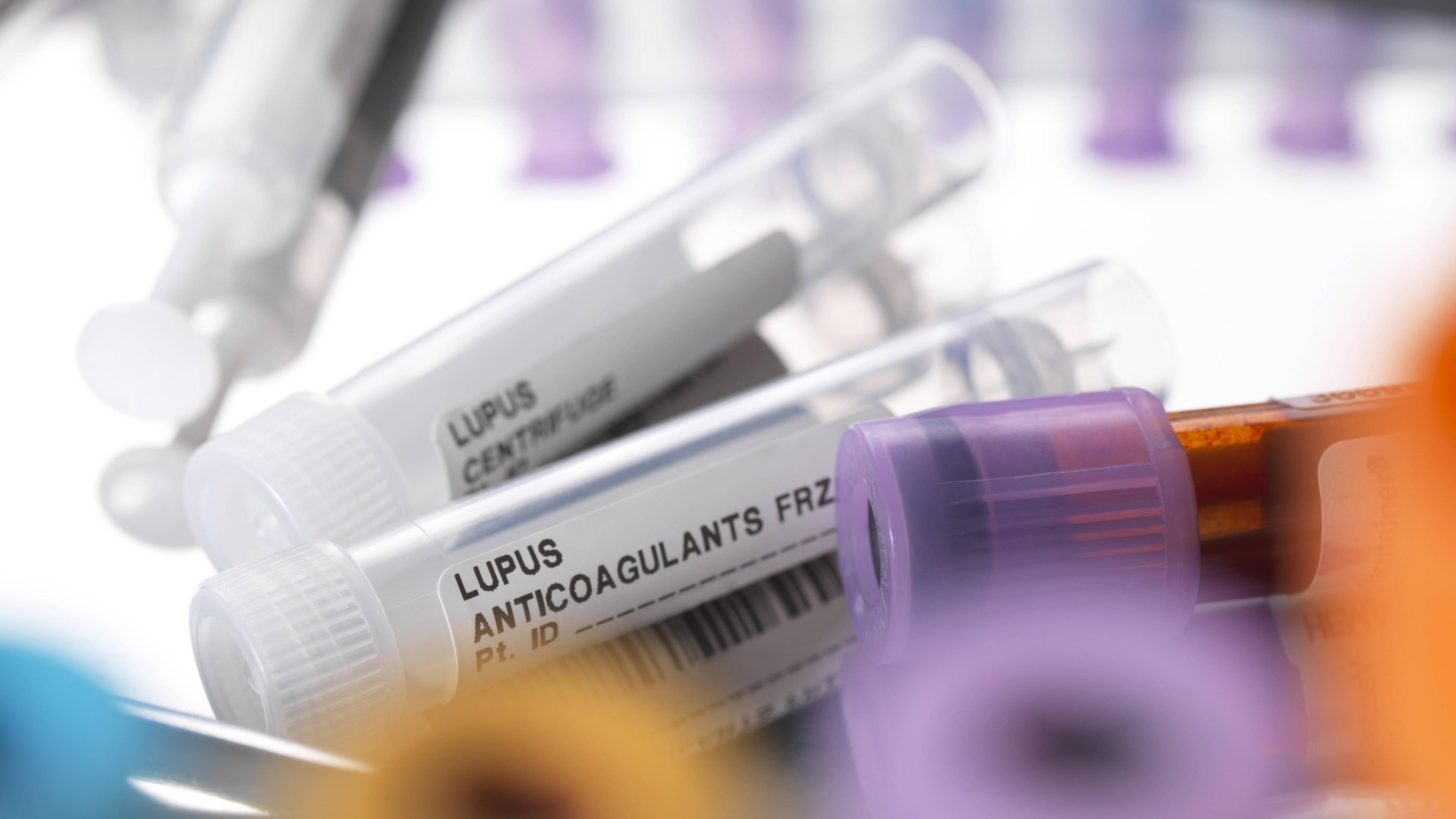 Zwei medizinische Röhren mit der Aufschrift "Lupus Anticoagulants" in einer Laborumgebung.