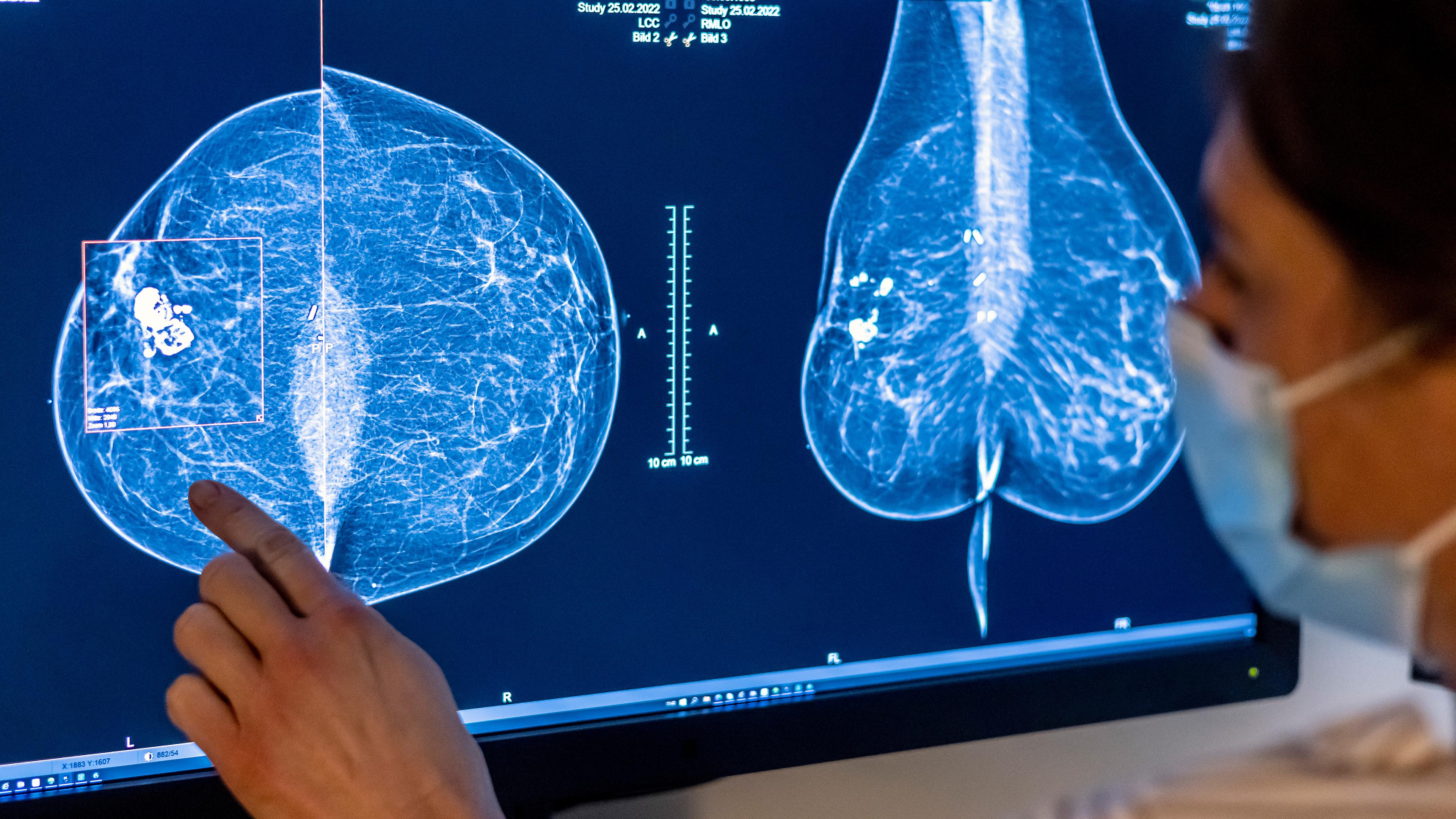 Medizinisches Personal untersucht mit einer Mammografie die Brust einer Frau auf Brustkrebs, aufgenommen am 25.02.2022