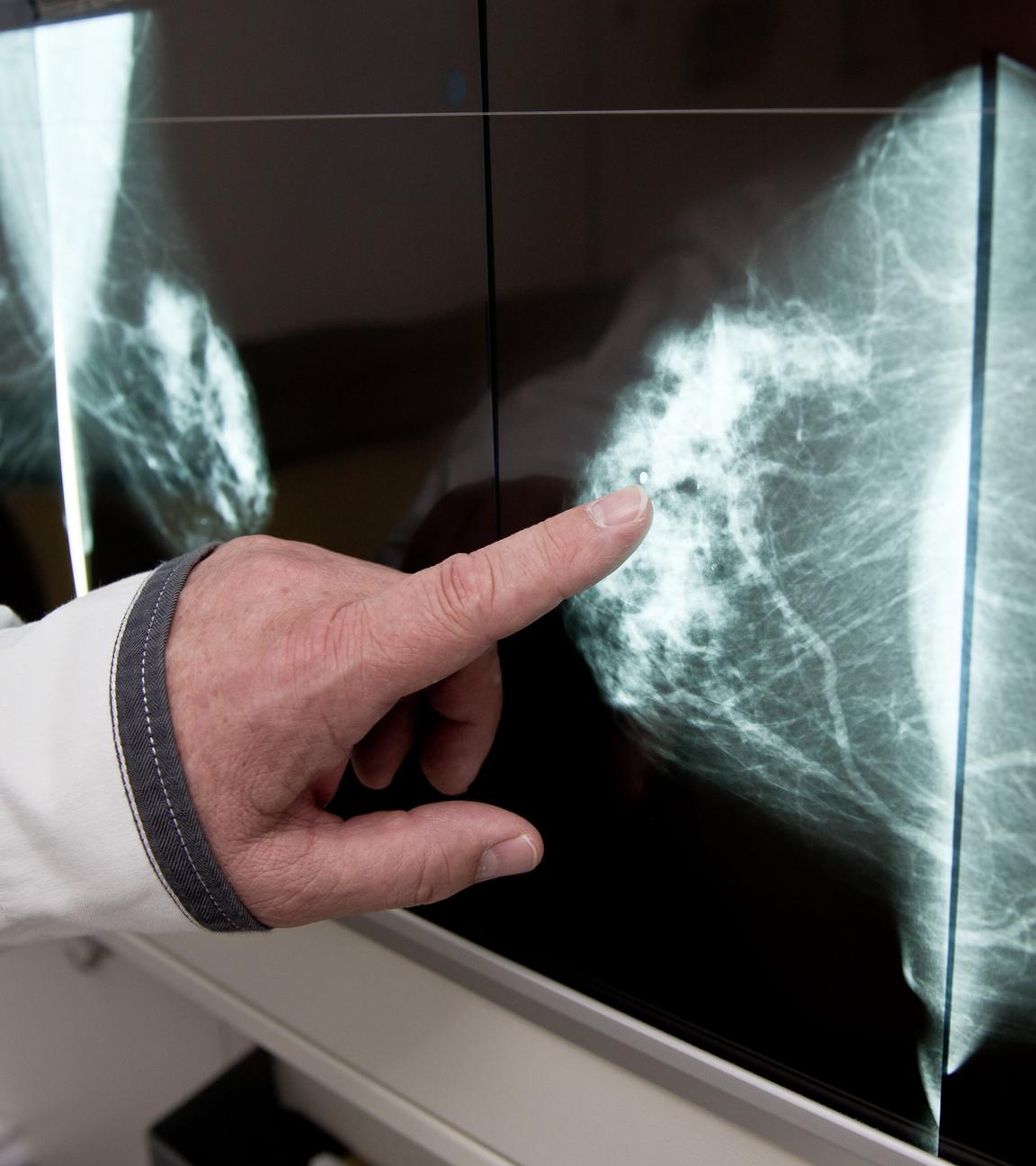 Medizinisches Personal untersucht mit einer Mammographie die Brust einer Frau auf Brustkrebs