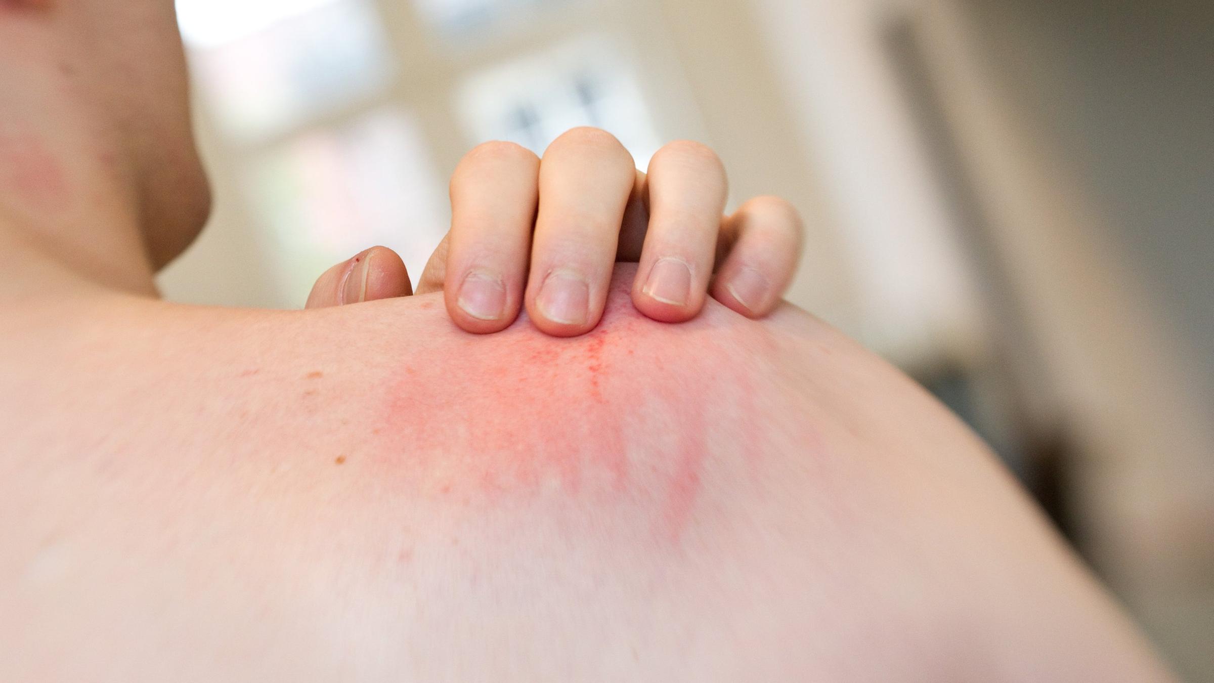 Skin-Picking: Zwanghaftes Zupfen an der Haut 