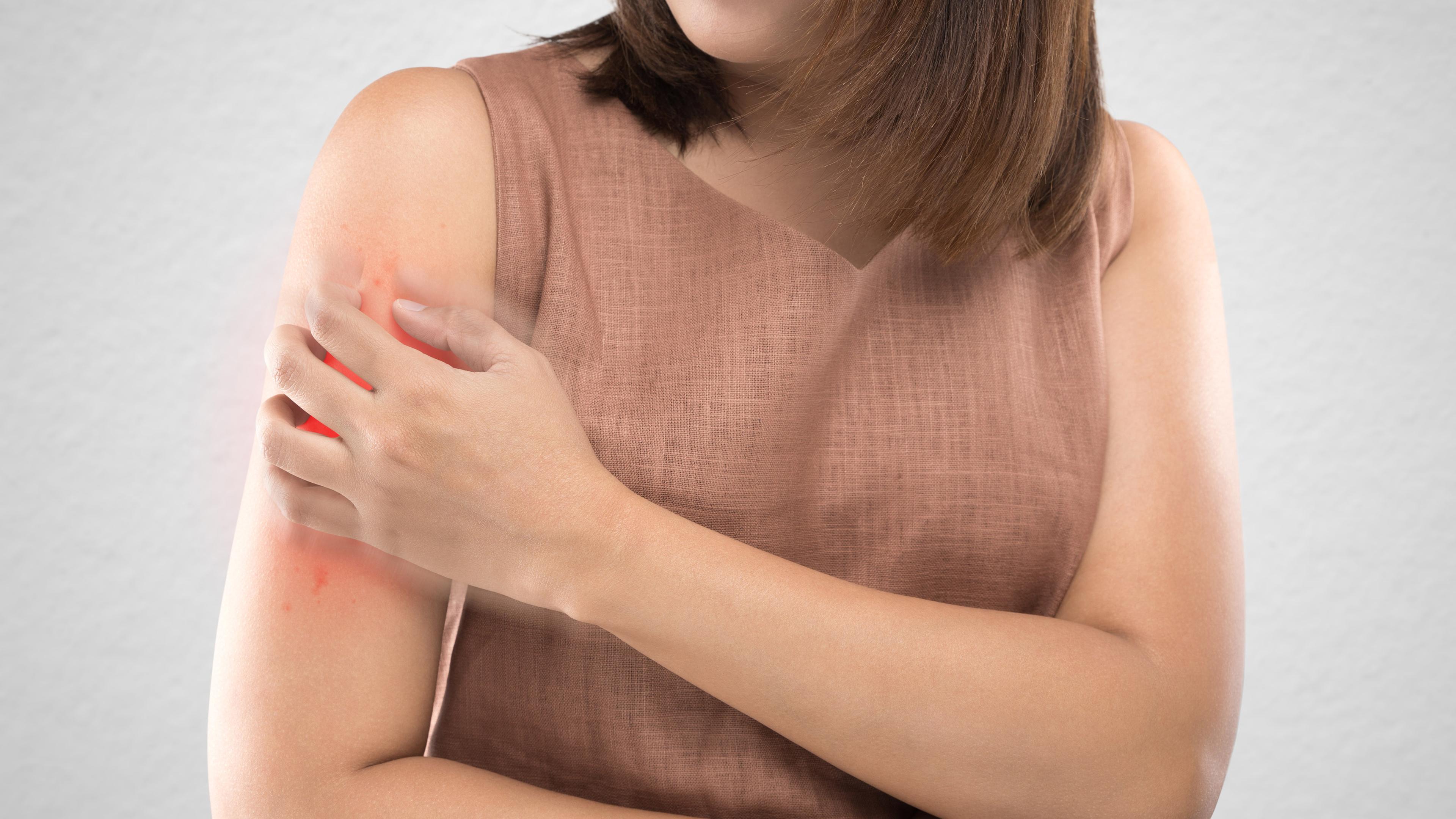 Eine Frau kratzt ihren entzündeten Insektenstich am Arm.