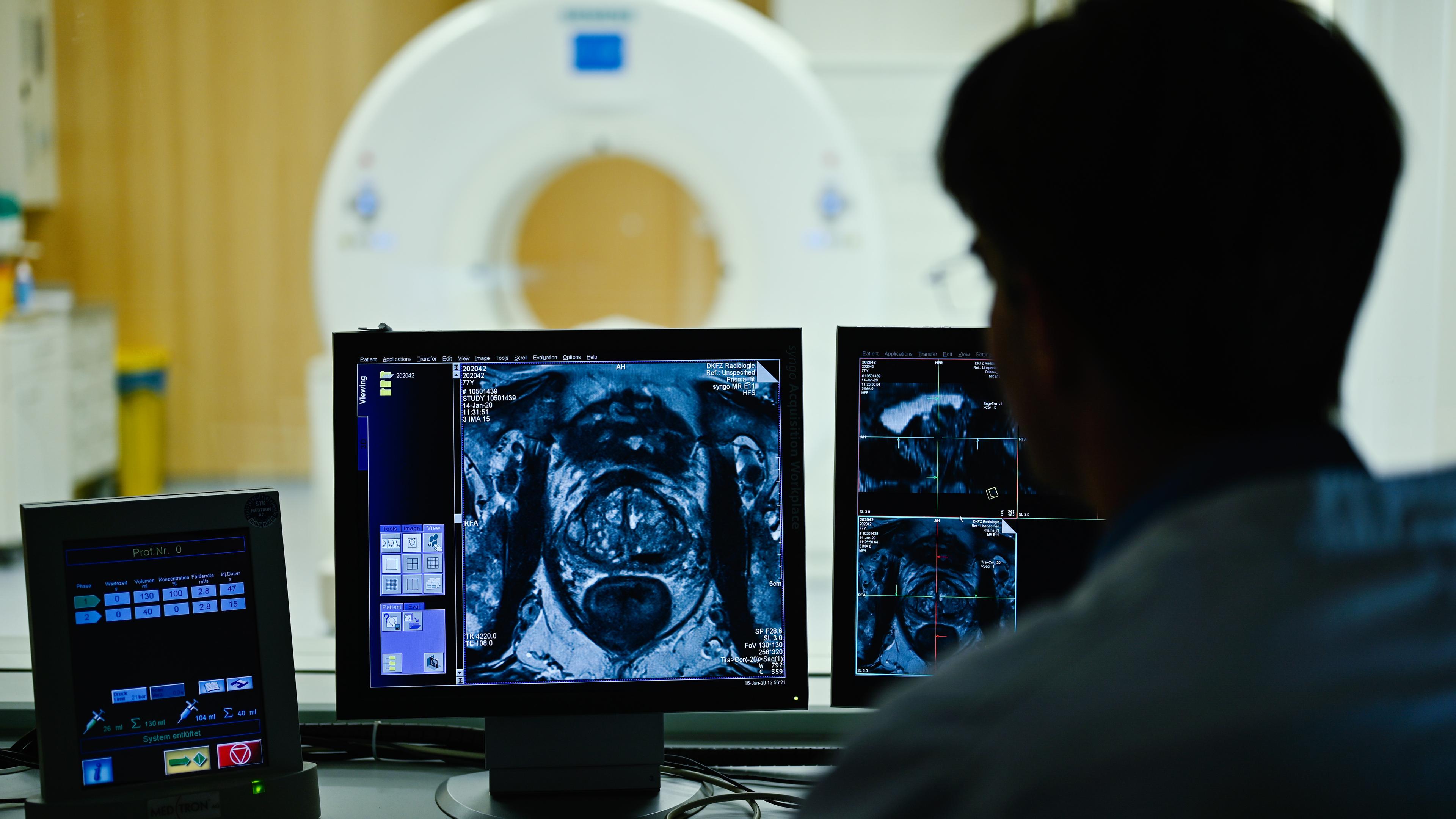 Ein Mitarbeiter betrachtet in einem Kontrollraum des Deutschen Krebsforschungszentrum (DKFZ) auf einem Monitor das Querschnittsbild einer Prostata.