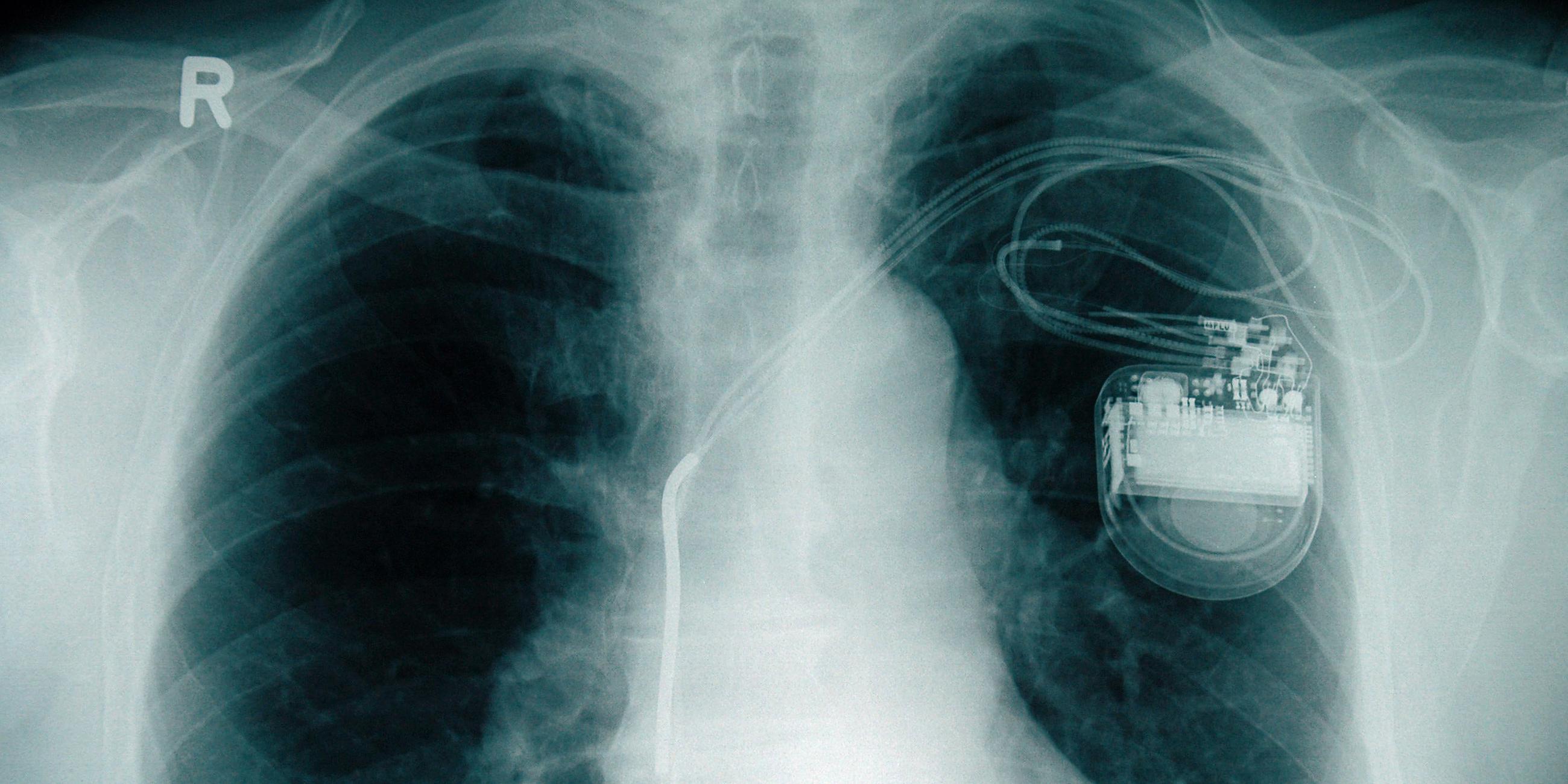 Archivfoto-Illustration: Röntgenbild mit Herzschrittmacher