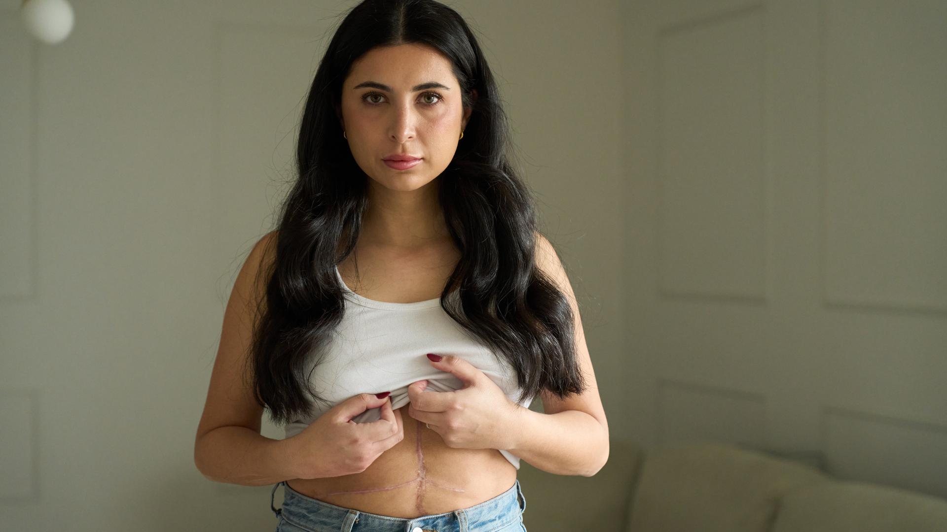 Sarah trägt ein weißes Trägertop, welches sie mit beiden Händen hochhält. Man sieht eine große Narbe über ihren Bauch. Sie schaut in die Kamera. 